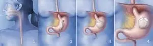intra-gastric balloon
