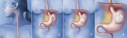 orbera intra-gastric balloon