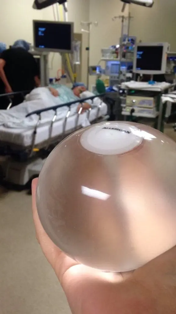 Dr. Curry's First Orbera Gastric Balloon Patient