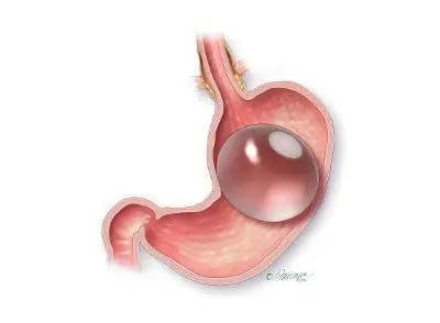 ORBERA In Stomach Orbera Intra-gastric Balloon