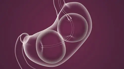 ReShape Balloon in Stomach