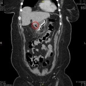CT scan of a staple line leaks after bariatric surgery