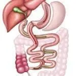 SIPS procedure is based on duodenal switch