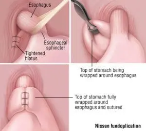 laparoscopic nissen fundoplication