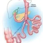 loop duodenal switch