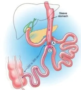 loop duodenal switch