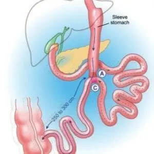 loop duodenal switch
