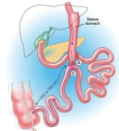 loop duodenal switch