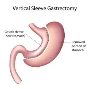 vertical sleeve gastrectomy