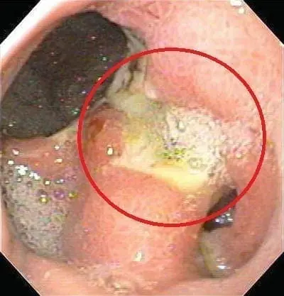 marginal ulcer