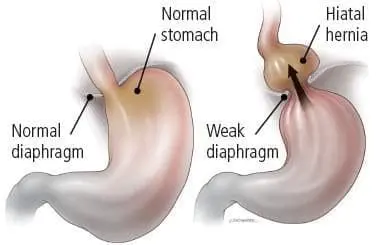 GERD hiatal hernia
