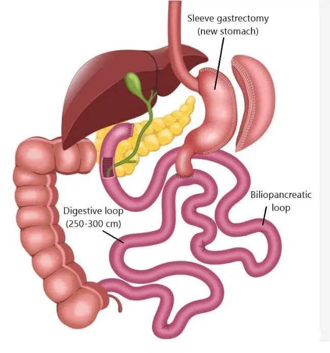 Anatomy of a SADI-S procedure, also known as SIPS or LDS.