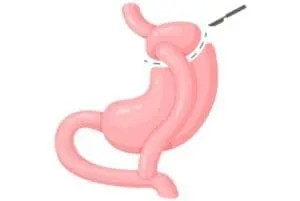 gastric bypass surgery