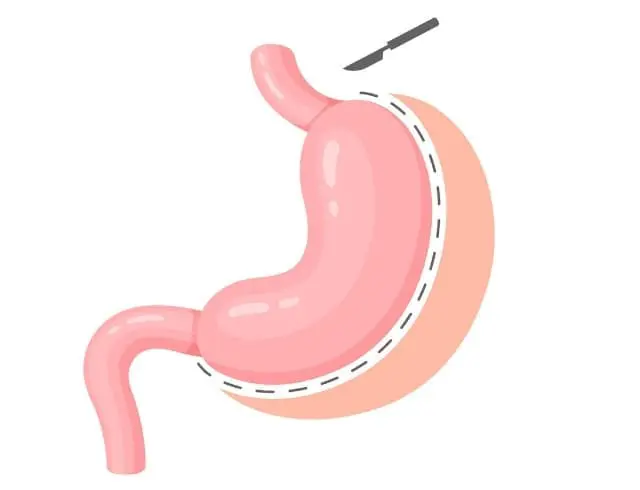 gastric sleeve Cincinnati