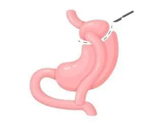 gastric sleeve revision anatomy 