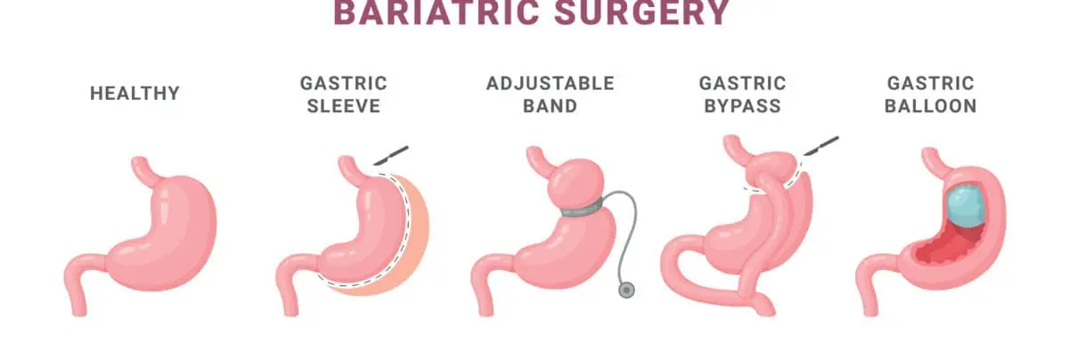 gastric bypass versus gastric sleeve