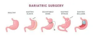 gastric bypass versus sleeve gastric bypass versus gastric sleeve