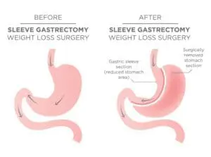gastric sleeve-VSG gastric sleeve/VSG anatomy