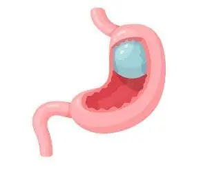 gastric balloon