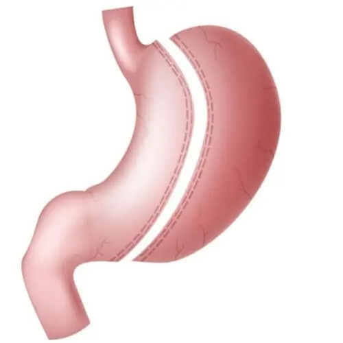 gastric sleeve anatomy