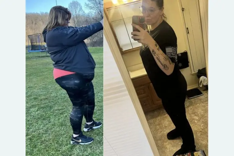 Rebeca before and after gastric sleeve surgery showing her 160-pound weight-loss result at JourneyLite