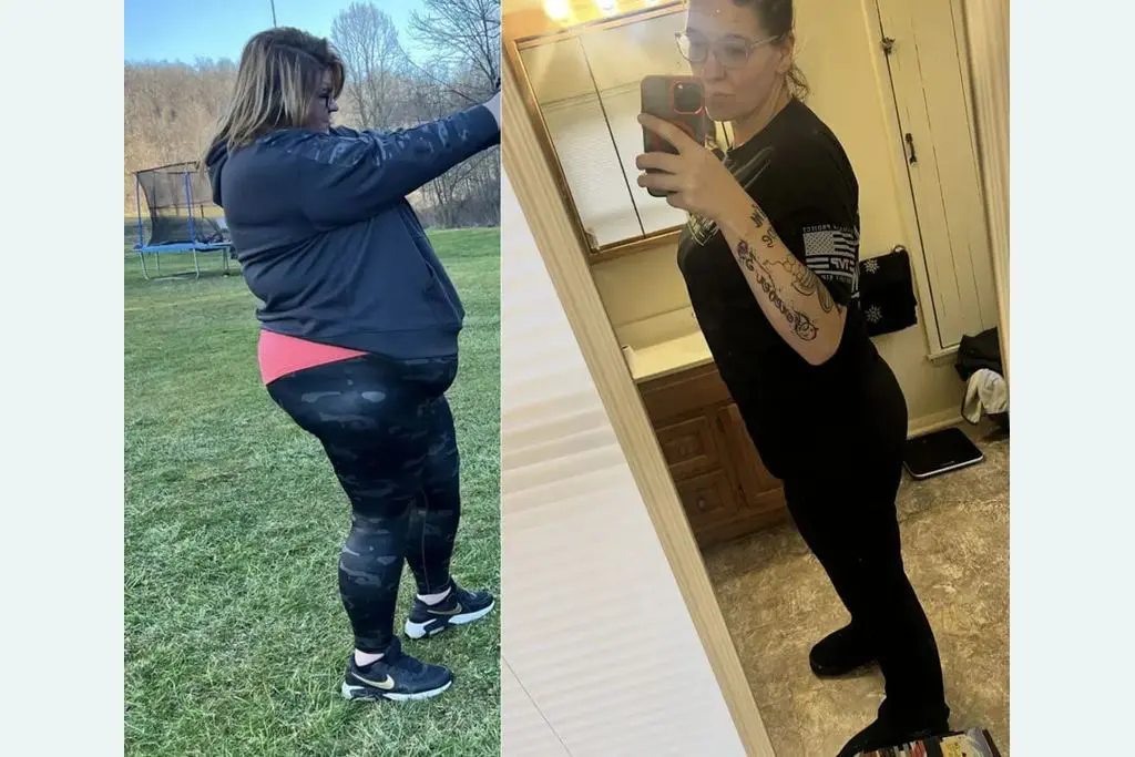 Rebeca before and after gastric sleeve surgery showing her 160-pound weight-loss result at JourneyLite