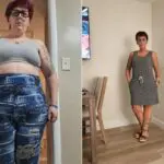 Alicia before and after gastric sleeve surgery showing her 147-pound weight-loss result at JourneyLite