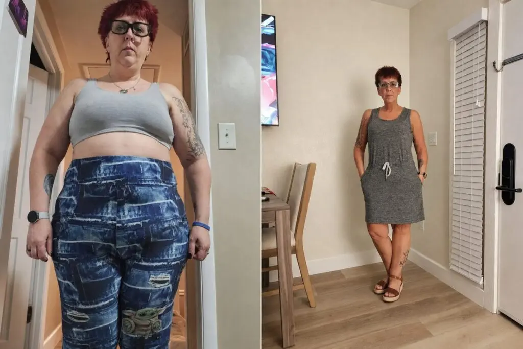 Alicia before and after gastric sleeve surgery showing her 147-pound weight-loss result at JourneyLite