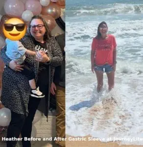 heather before and after losing 110 lbs with the VSG (gastric sleeve) at JourneyLite