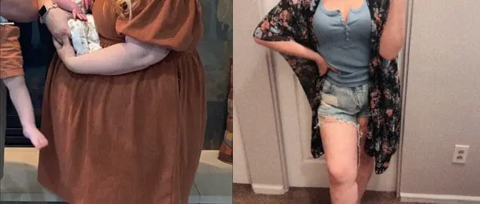 callie before and after losing 187 pounds with gastric sleeve surgery