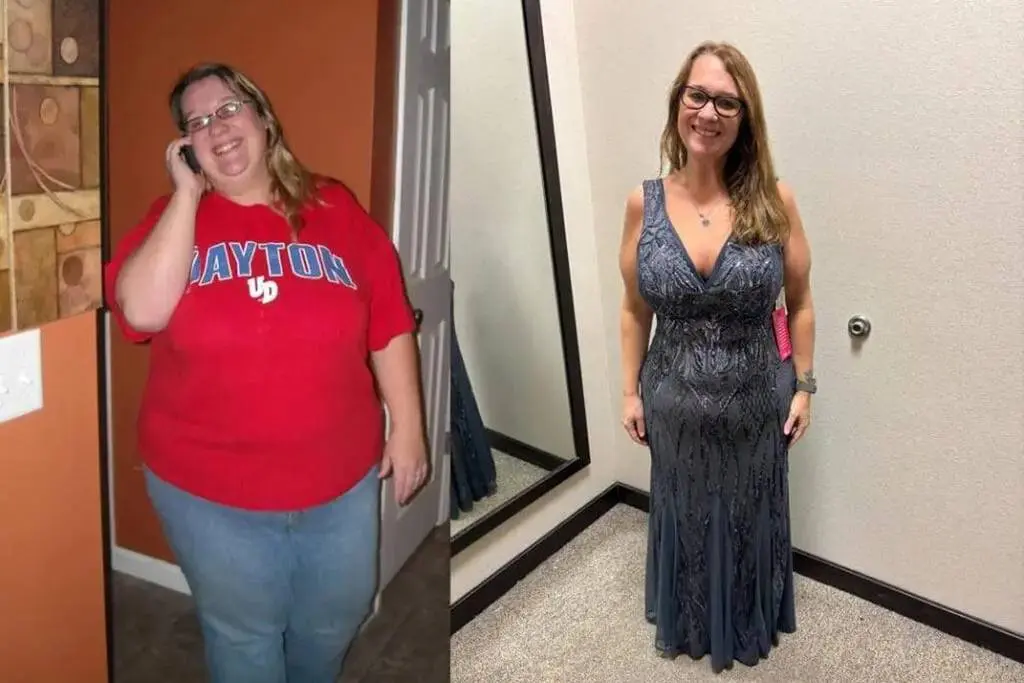 Rebecca before and after gastric sleeve surgery showing her 136-pound weight-loss result at JourneyLite