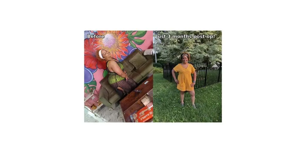 Alona before and after gastric sleeve surgery