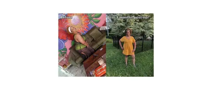 Alona before and after VSG featured