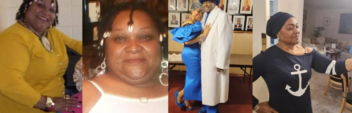 audrey before and after gastric sleeve (vsg) at journeylite