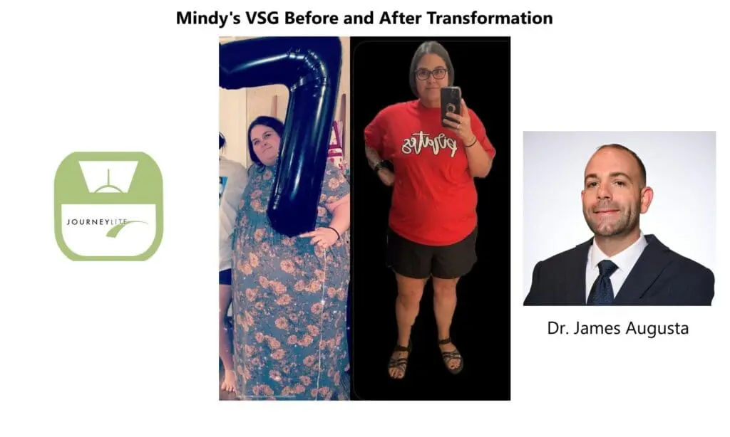 Mindy before and after gastric sleeve surgery