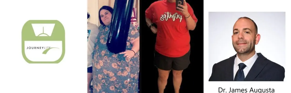 Mindy's VSG before and after story