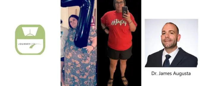 Mindy's VSG before and after story