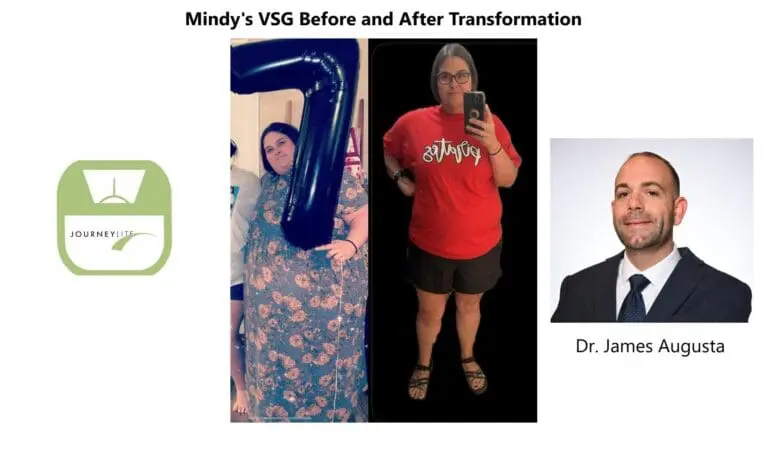 Mindy before and after gastric sleeve surgery