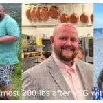 Bobby's VSG before and after transformation