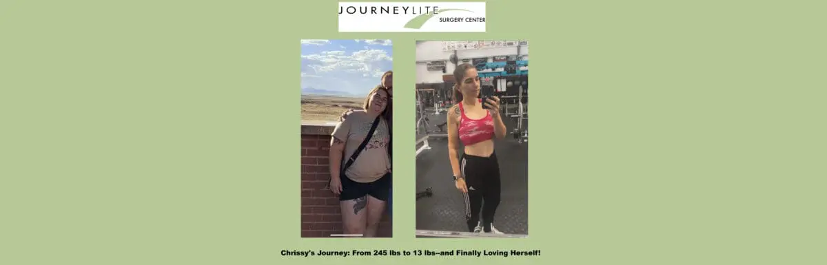 Chrissy’s gastric sleeve transformation at JourneyLite—side-by-side before and after, from 245 lbs to 130 lbs, confident and healthy.