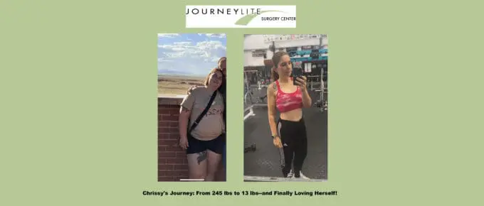 Chrissy’s gastric sleeve transformation at JourneyLite—side-by-side before and after, from 245 lbs to 130 lbs, confident and healthy.