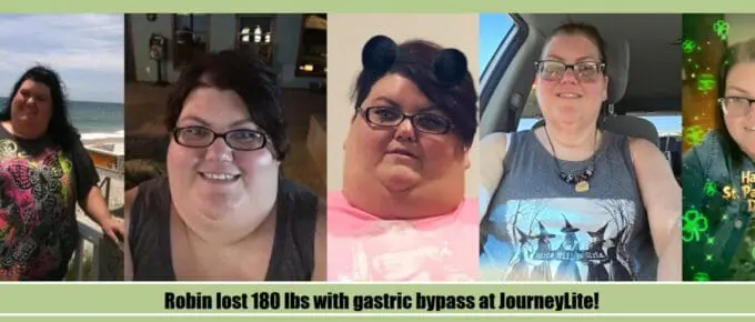 Wide before-and-after photo collage of Robin’s gastric bypass weight loss journey, showing several pre-surgery images on the left and healthier, slimmer post-surgery images on the right after treatment with Dr. James Augusta at JourneyLite.