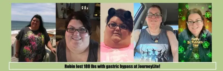 Robin before and after gastric bypass surgery