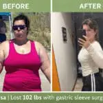 Before-and-after weight loss photos of Alisa following gastric sleeve surgery at JourneyLite, showing significant transformation from 252 pounds to 150 pounds.