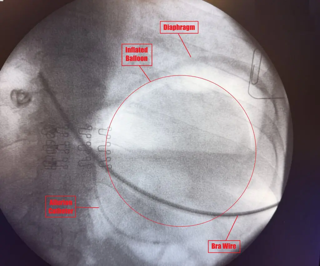 Final confirmation X-ray showing an inflated Allurion gastric balloon positioned in the stomach with the catheter still attached.