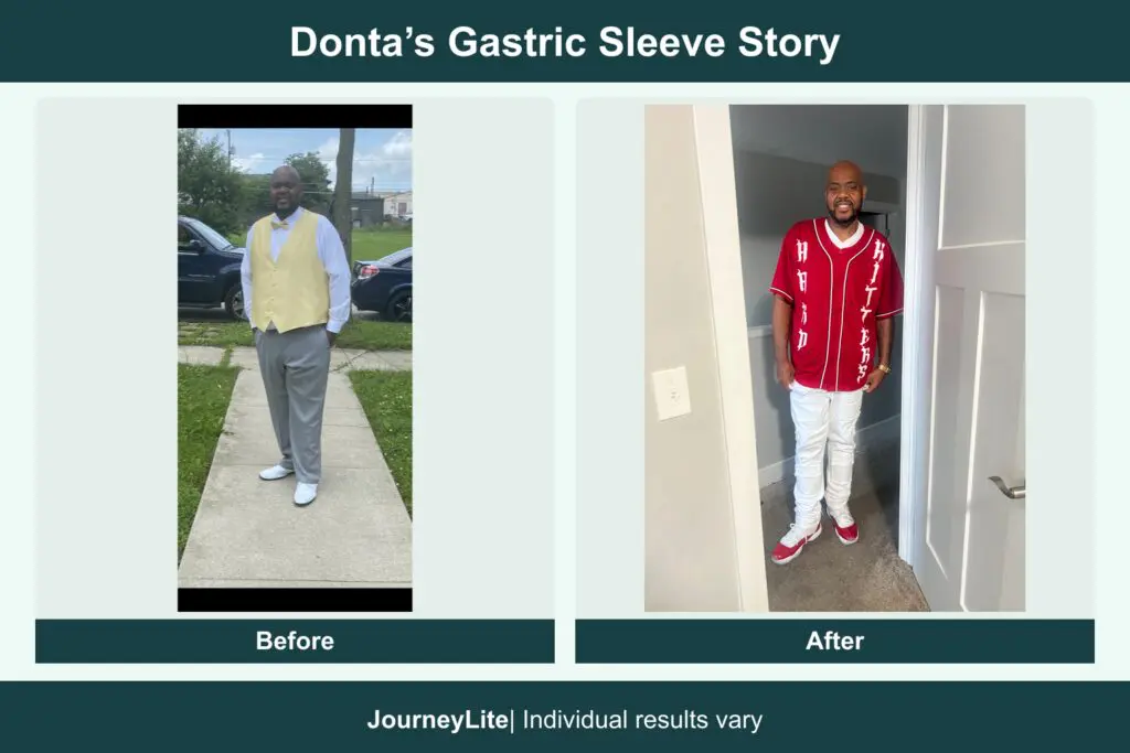 Donta before and after gastric sleeve surgery, using patient-submitted photos