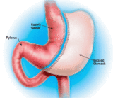 Vertical Sleeve Gastrectomy
