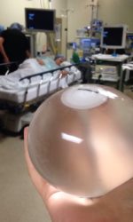 Dr. Curry's First Orbera Gastric Balloon Patient