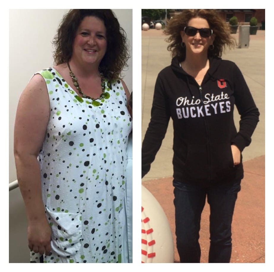 Gastric Sleeve Before And After Picture