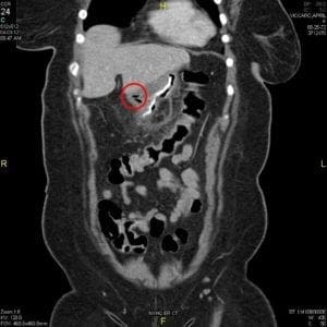 CT scan of a staple line leaks after bariatric surgery